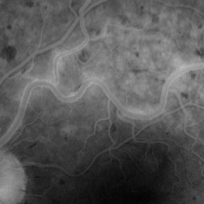 Angiogram showing inflammation